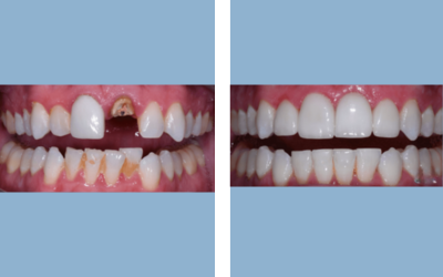 Before and After